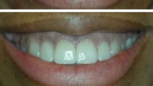 porcelain-veneers-1215-f