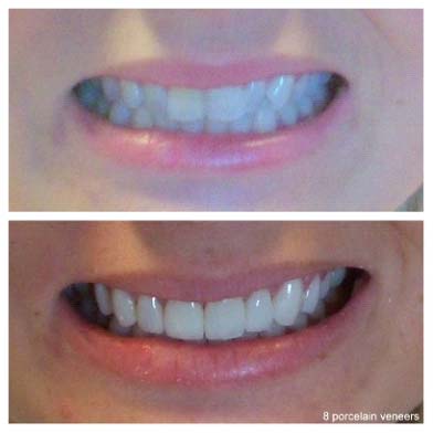 8-porcelain-veneers
