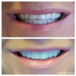 8-veneers-correct-chips-f
