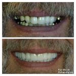 Full-mouth-rehab-f