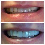 crowns-veneers-and-bridge-transform-smile-f