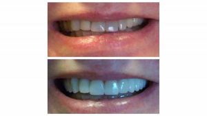 crowns-veneers-and-bridge-transform-smile-f